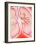 Lungs with Bronchitis-John Bavosi-Framed Photographic Print