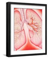 Lungs with Bronchitis-John Bavosi-Framed Photographic Print