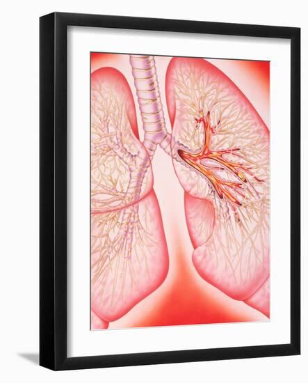 Lungs with Bronchitis-John Bavosi-Framed Photographic Print