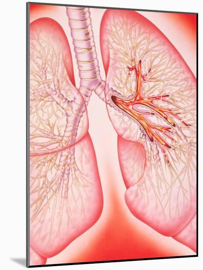 Lungs with Bronchitis-John Bavosi-Mounted Photographic Print