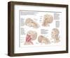 Medical Chart Showing the Range of Injuries to the Human Neck Caused by Whiplash-null-Framed Art Print