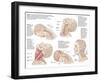 Medical Chart Showing the Range of Injuries to the Human Neck Caused by Whiplash-null-Framed Art Print