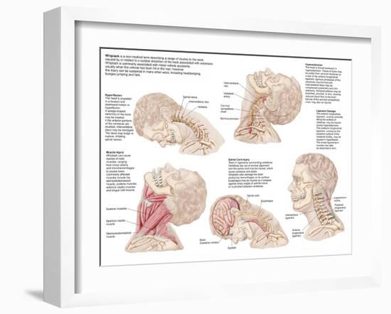 Medical Chart Showing the Range of Injuries to the Human Neck Caused by Whiplash-null-Framed Art Print