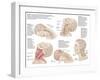 Medical Chart Showing the Range of Injuries to the Human Neck Caused by Whiplash-null-Framed Art Print