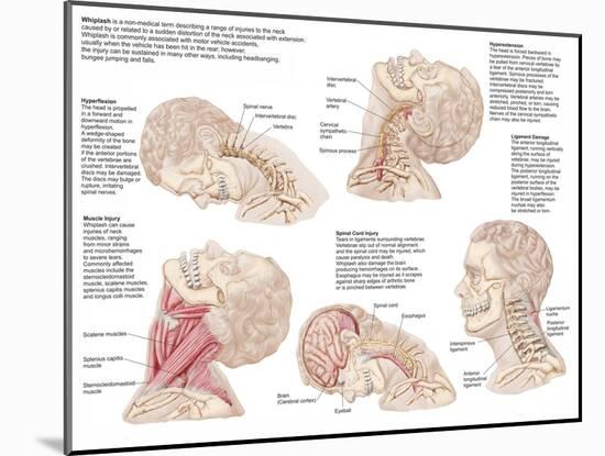 Medical Chart Showing the Range of Injuries to the Human Neck Caused by Whiplash-null-Mounted Art Print