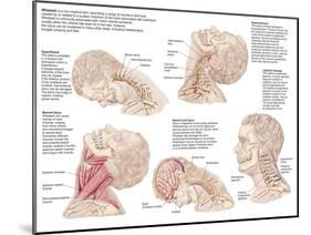 Medical Chart Showing the Range of Injuries to the Human Neck Caused by Whiplash-null-Mounted Art Print