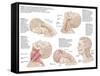 Medical Chart Showing the Range of Injuries to the Human Neck Caused by Whiplash-null-Framed Stretched Canvas