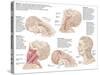 Medical Chart Showing the Range of Injuries to the Human Neck Caused by Whiplash-null-Stretched Canvas