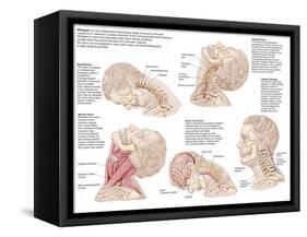 Medical Chart Showing the Range of Injuries to the Human Neck Caused by Whiplash-null-Framed Stretched Canvas