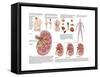 Medical Chart Showing the Signs and Symptoms of Kidney Stones-null-Framed Stretched Canvas