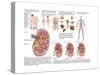 Medical Chart Showing the Signs and Symptoms of Kidney Stones-null-Stretched Canvas