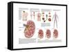 Medical Chart Showing the Signs and Symptoms of Kidney Stones-null-Framed Stretched Canvas