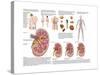 Medical Chart Showing the Signs and Symptoms of Kidney Stones-null-Stretched Canvas