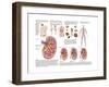 Medical Chart Showing the Signs and Symptoms of Kidney Stones-null-Framed Art Print