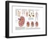 Medical Chart Showing the Signs and Symptoms of Kidney Stones-null-Framed Art Print