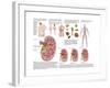 Medical Chart Showing the Signs and Symptoms of Kidney Stones-null-Framed Art Print