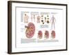 Medical Chart Showing the Signs and Symptoms of Kidney Stones-null-Framed Art Print