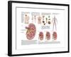 Medical Chart Showing the Signs and Symptoms of Kidney Stones-null-Framed Art Print
