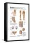 Medical Chart Showing the Signs and Symptoms of Sciatica-null-Framed Stretched Canvas