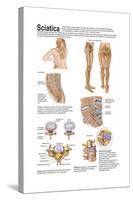 Medical Chart Showing the Signs and Symptoms of Sciatica-null-Stretched Canvas