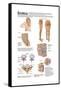 Medical Chart Showing the Signs and Symptoms of Sciatica-null-Framed Stretched Canvas