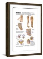 Medical Chart Showing the Signs and Symptoms of Sciatica-null-Framed Art Print