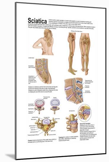 Medical Chart Showing the Signs and Symptoms of Sciatica-null-Mounted Art Print