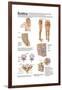 Medical Chart Showing the Signs and Symptoms of Sciatica-null-Framed Art Print