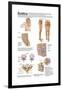 Medical Chart Showing the Signs and Symptoms of Sciatica-null-Framed Art Print