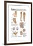 Medical Chart Showing the Signs and Symptoms of Sciatica-null-Framed Art Print