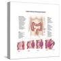 Medical Illustration Depicting the Different Stages of Colon Cancer-null-Stretched Canvas