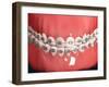 Medical Illustration of Human Mouth Showing Teeth, Gums and Metal Braces-null-Framed Art Print