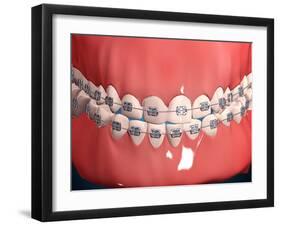 Medical Illustration of Human Mouth Showing Teeth, Gums and Metal Braces-null-Framed Art Print