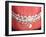 Medical Illustration of Human Mouth Showing Teeth, Gums and Metal Braces-null-Framed Art Print