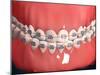 Medical Illustration of Human Mouth Showing Teeth, Gums and Metal Braces-null-Mounted Art Print