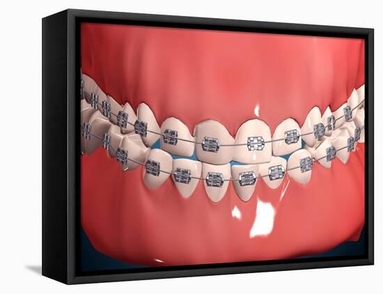 Medical Illustration of Human Mouth Showing Teeth, Gums and Metal Braces-null-Framed Stretched Canvas