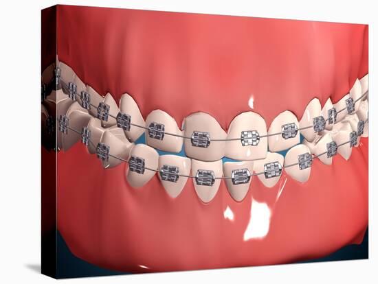 Medical Illustration of Human Mouth Showing Teeth, Gums and Metal Braces-null-Stretched Canvas