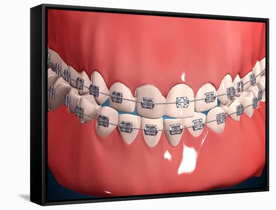 Medical Illustration of Human Mouth Showing Teeth, Gums and Metal Braces-null-Framed Stretched Canvas