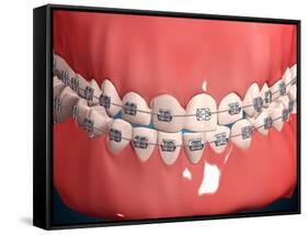 Medical Illustration of Human Mouth Showing Teeth, Gums and Metal Braces-null-Framed Stretched Canvas