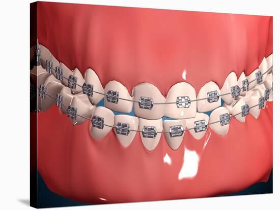 Medical Illustration of Human Mouth Showing Teeth, Gums and Metal Braces-null-Stretched Canvas