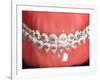 Medical Illustration of Human Mouth Showing Teeth, Gums and Metal Braces-null-Framed Art Print