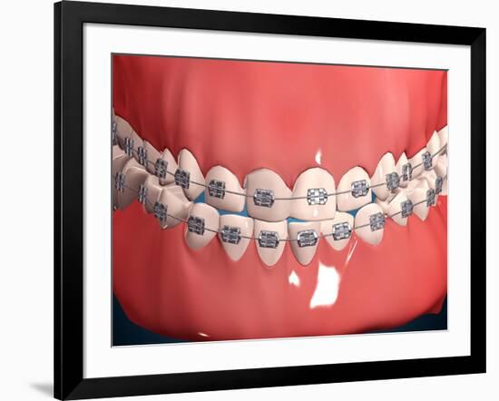 Medical Illustration of Human Mouth Showing Teeth, Gums and Metal Braces-null-Framed Art Print