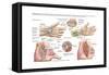 Medical Illustration Showing Carpal Tunnel Syndrome in the Human Wrist-null-Framed Stretched Canvas