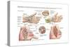 Medical Illustration Showing Carpal Tunnel Syndrome in the Human Wrist-null-Stretched Canvas