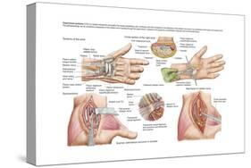 Medical Illustration Showing Carpal Tunnel Syndrome in the Human Wrist-null-Stretched Canvas
