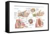 Medical Illustration Showing Carpal Tunnel Syndrome in the Human Wrist-null-Framed Stretched Canvas