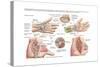 Medical Illustration Showing Carpal Tunnel Syndrome in the Human Wrist-null-Stretched Canvas