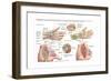 Medical Illustration Showing Carpal Tunnel Syndrome in the Human Wrist-null-Framed Art Print