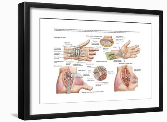Medical Illustration Showing Carpal Tunnel Syndrome in the Human Wrist-null-Framed Art Print