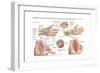 Medical Illustration Showing Carpal Tunnel Syndrome in the Human Wrist-null-Framed Art Print